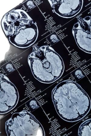 Исследование факторов риска инсульта