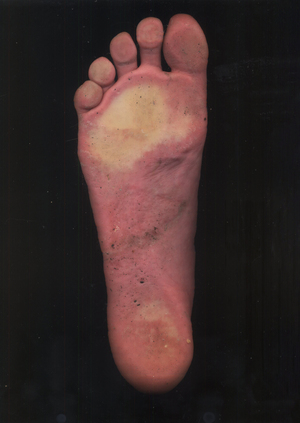 pes, planta, pediculus