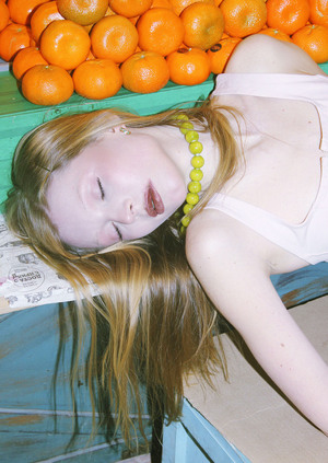 hypersomnia