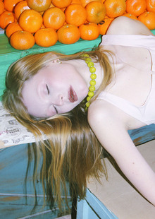 hypersomnia